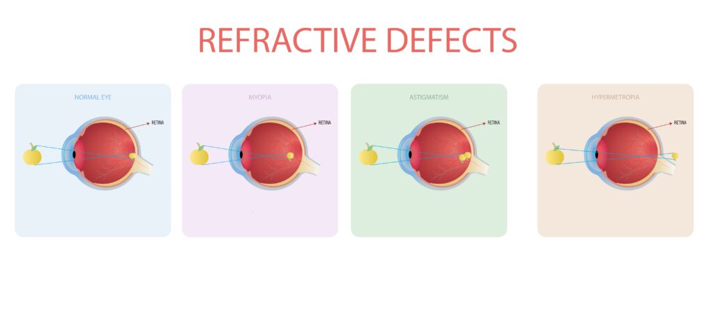 Diagram comparing myopia, hyperopia, and astigmatism