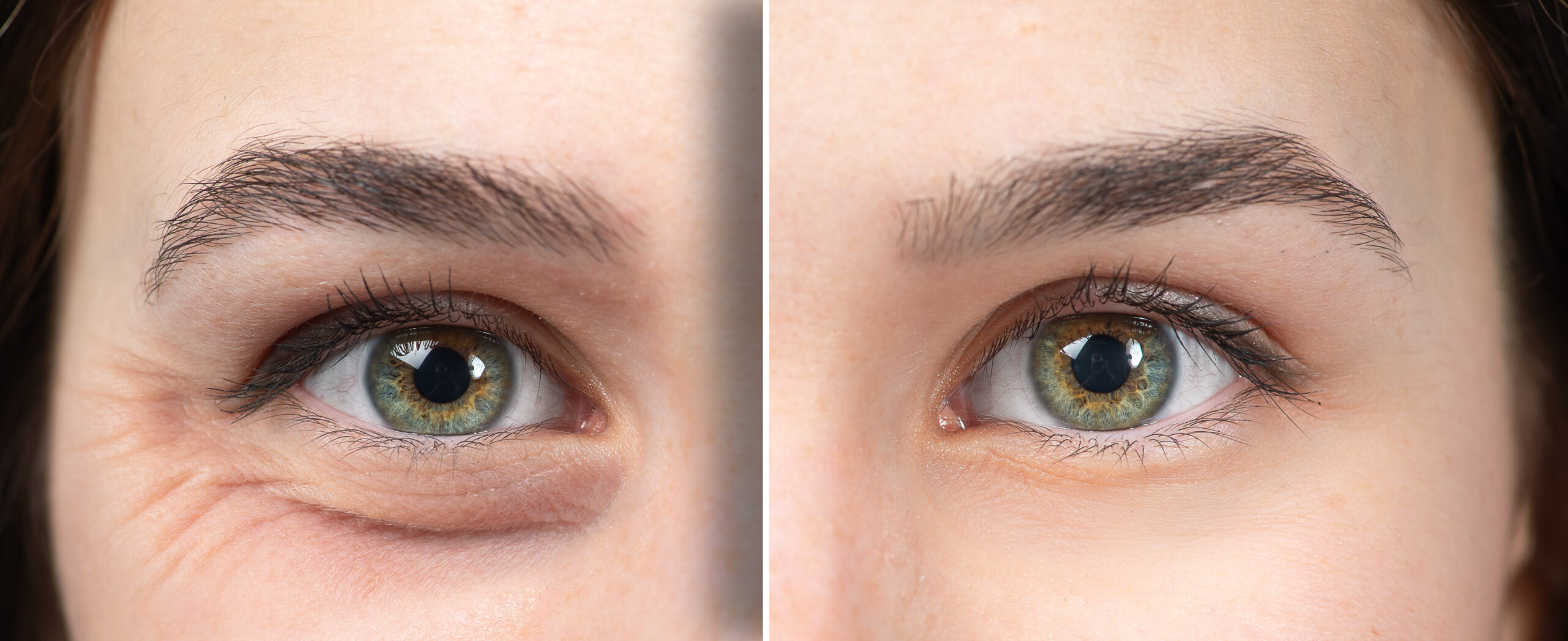 Woman's eyes before and after botulinum toxin ("botox") injections for wrinkles, fine lines around the eyes ("crow's feet")