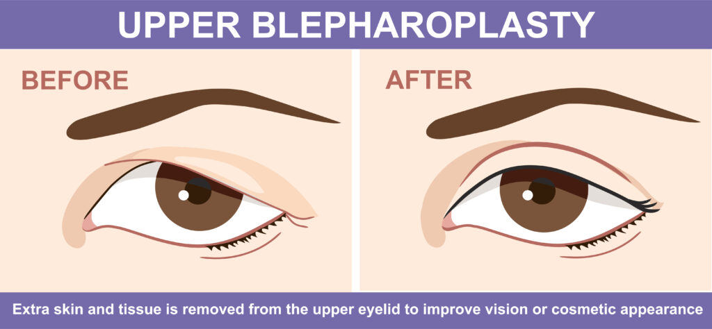 Blepharoplasty or "eyelid lift" of the upper eyelid, before and after.