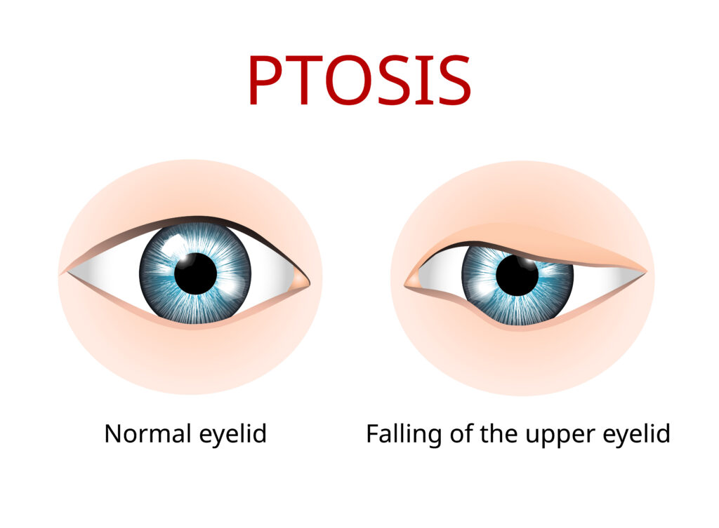 Ptosis, or eyelid drooping of the upper eyelid